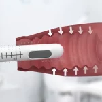Maschine zur Vaginalstraffung