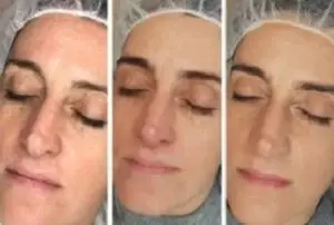 Was ist Microneedling mit RF? Eine Einführung in die ästhetische Behandlung