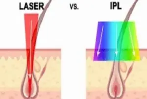 Laser gegen IPL Haarentfernung: Welche Methode passt zu Ihnen?