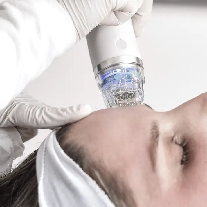 HIFU 5D Microneedling mit Radiofrequenz - Nahaufnahme Gesichtsbehandlung