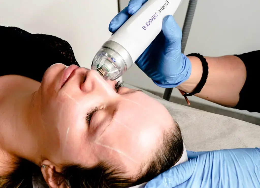 Anwendung HIFU 5D Microneedling mit Radiofrequenz im Gesicht