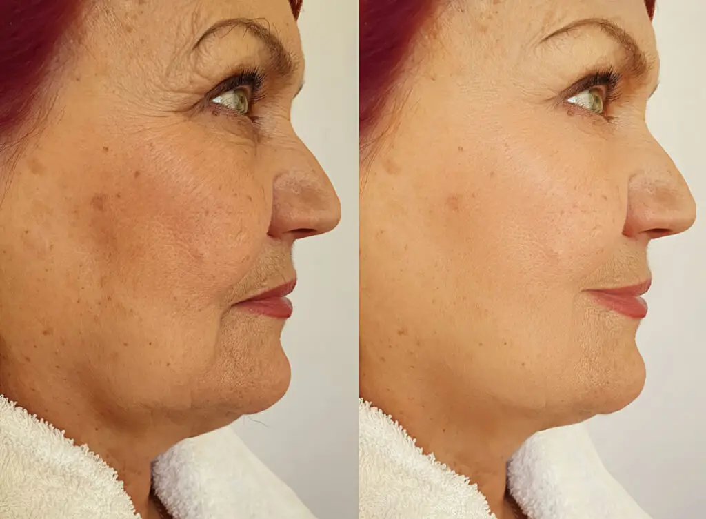 HIFU 5D Microneedling mit Radiofrequenz Behandlung - Vorher/Nachher Facelifting (Gesichtslifting)