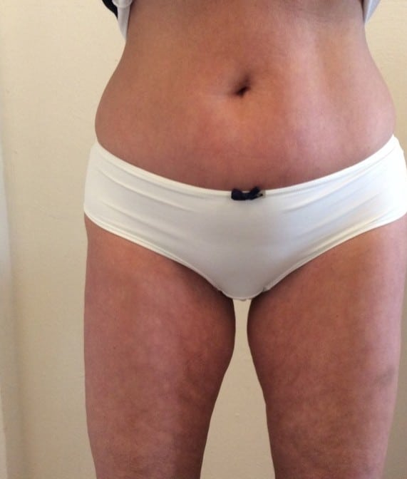lipolaser nachher