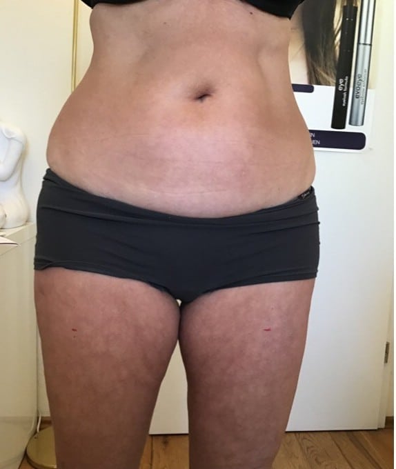 lipolaser 6d