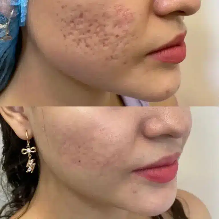 Pinxel-V/ Vakuum Microneedling 1 microneedling rheinfelden